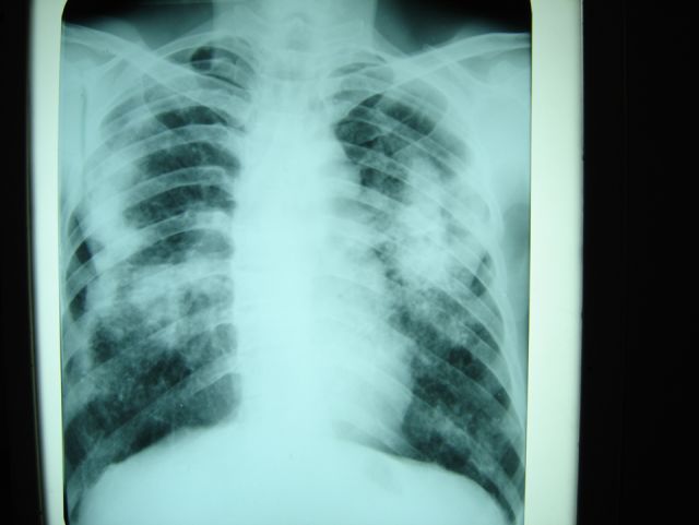叁期矽肺胸片 (3)中毒作用:某些粉尘如含有铅,砷等有毒化学物质,还可