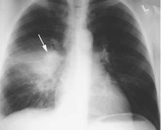 肺结核的影像学表现(多图)