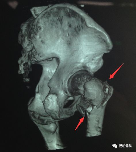 右股骨粗隆间粉碎性骨折