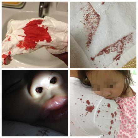 5岁娃打个喷嚏,枕头被子上到处是血,医生说的话让家人