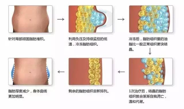 瘦腿贴原理是什么_瘦腿针原理图片(2)