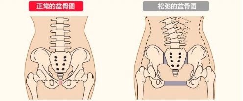 耻骨联合被撑开导致的耻骨分离和骨盆扩张. 2,盆底肌松弛