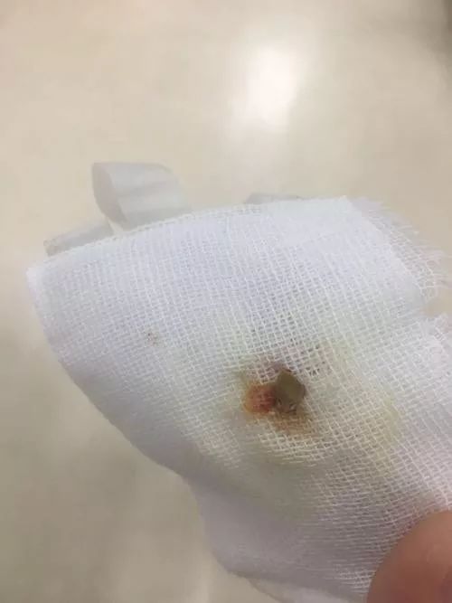 男子在深圳某医院做阑尾炎手术,7个月后伤口化脓流出西瓜籽!