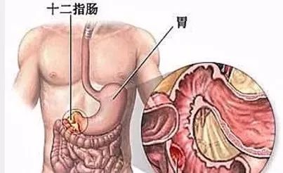 胃镜结果显示:十二指肠球部溃疡,浅表性胃炎及胃黏膜贫血相.