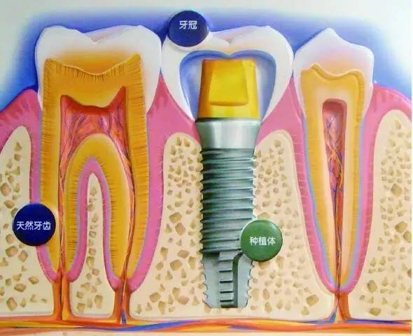 三分钟带你了解种植牙与烤瓷牙的区别！