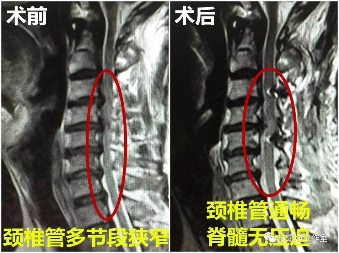 发育性颈椎管狭窄实质是一种特殊的"发育异常",在人体的正常生长过程