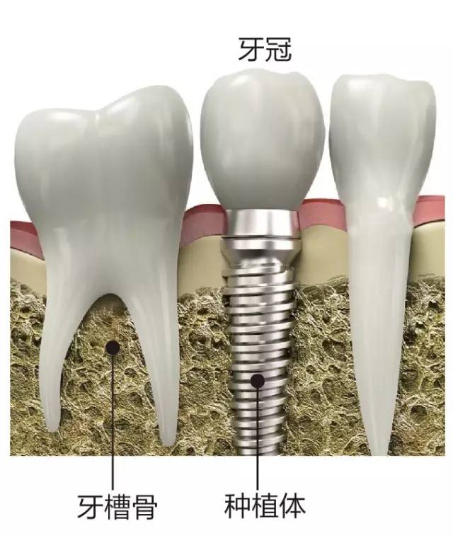 三分钟带你了解种植牙与烤瓷牙的区别！