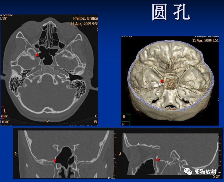 解剖丨颅底孔道及内容物