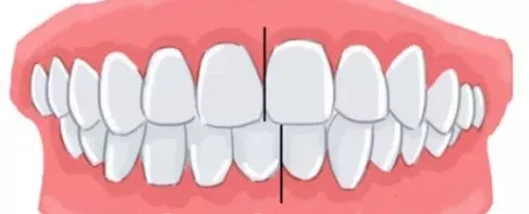 我这样的牙齿需要整整吗?