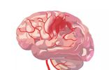 一,出血性卒中脑卒中即脑血管病,一般分为两大类:出血性卒中和缺血性