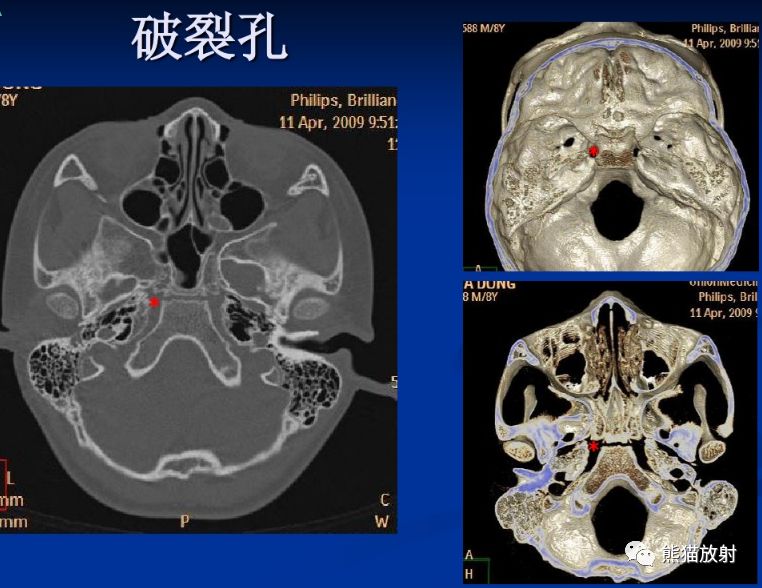 解剖丨颅底孔道及内容物