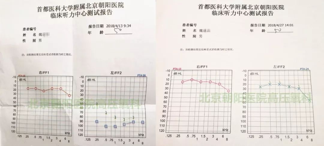 高压氧治疗前后魏先生的听力测试报告对比