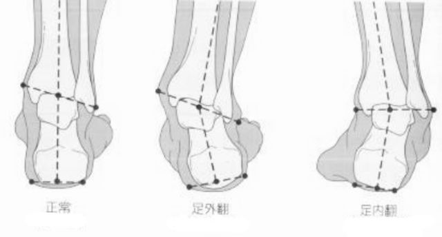 足内翻和足外翻示意图(右脚)