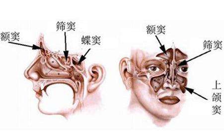 鼻窦炎的症状是什么治疗方法有哪些