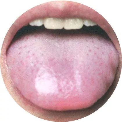 淡白 舌体:胖嫩 舌苔:白色 这种舌象大多是由于脾胃虚寒,气血不足形成