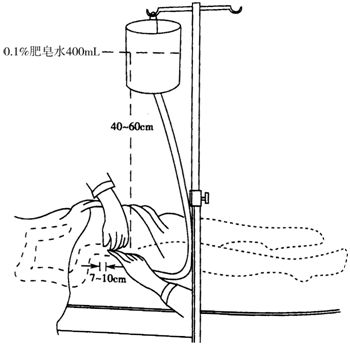 a.患者体位 b.肛管插入直肠的深度 c.灌肠溶液的名称 d.