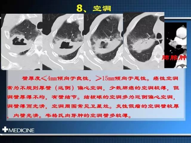 肺部结节的11种鉴别诊断方法