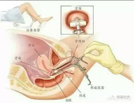 么21到29岁女性宫颈癌筛查推荐的是细胞学筛