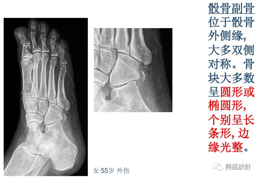 籽骨,副骨,永存骨骺,撕脱骨折?读完此文,你就懂了!