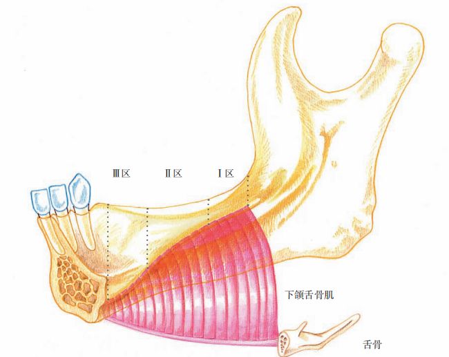 图4 下颌舌骨肌在下颌骨体内侧的情形,以及Ⅰ区Ⅱ区Ⅲ区的分布关键