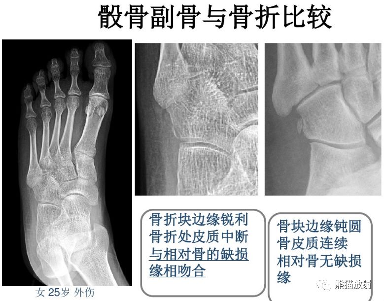 籽骨,副骨,永存骨骺,撕脱骨折?读完此文,你就懂了!