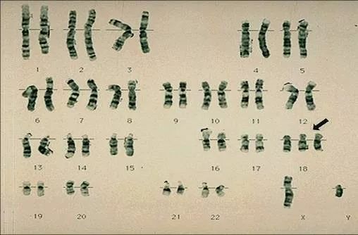 如down(21三体)综合征patau(13三体)综合征和edward(18三体)综合征等