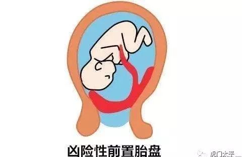 母婴 正文  科普:凶险型前置胎盘到底有多凶险?