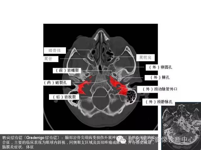 颅底孔道解剖详解