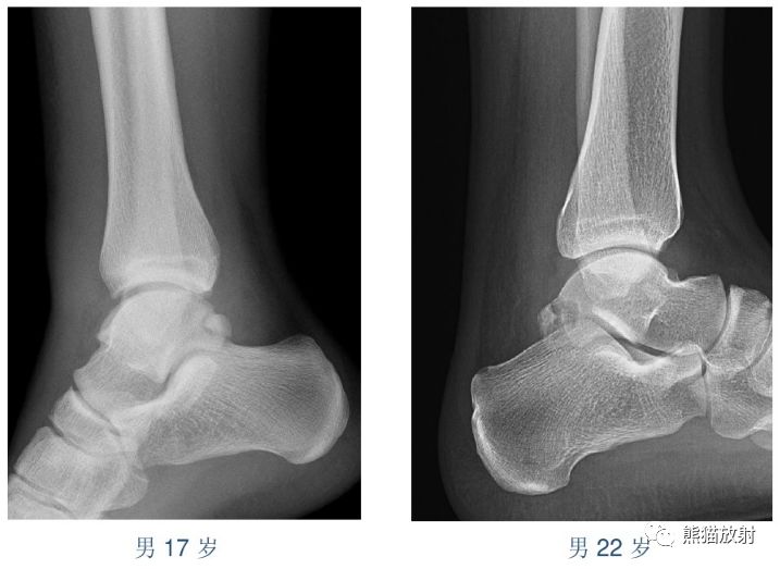 籽骨,副骨,永存骨骺,撕脱骨折?读完此文,你就懂了!