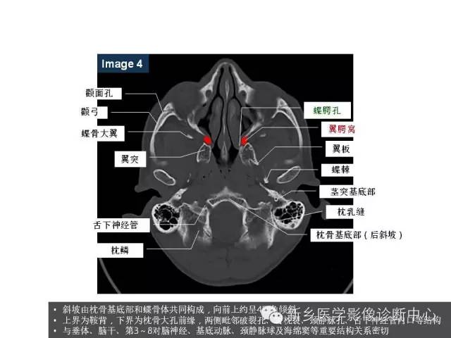 颅底孔道解剖详解