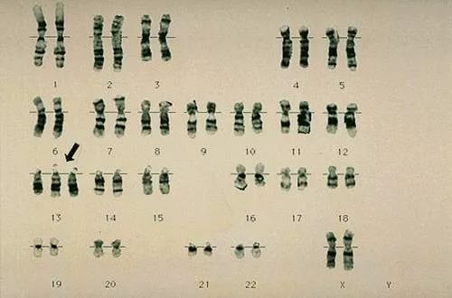 插入,重复和环状染色体等又可分为常染色体畸变,如down(21三体)综合征