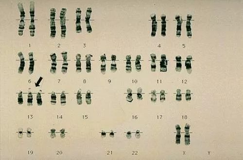如down(21三体)综合征patau(13三体)综合征和edward(18三体)综合征等