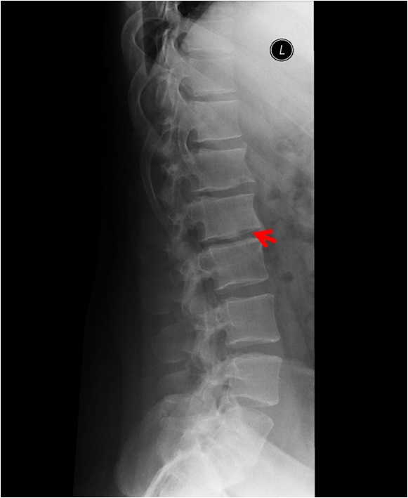 根据腰椎核磁诊断强直性脊柱炎放射科大夫要会突破思维定势