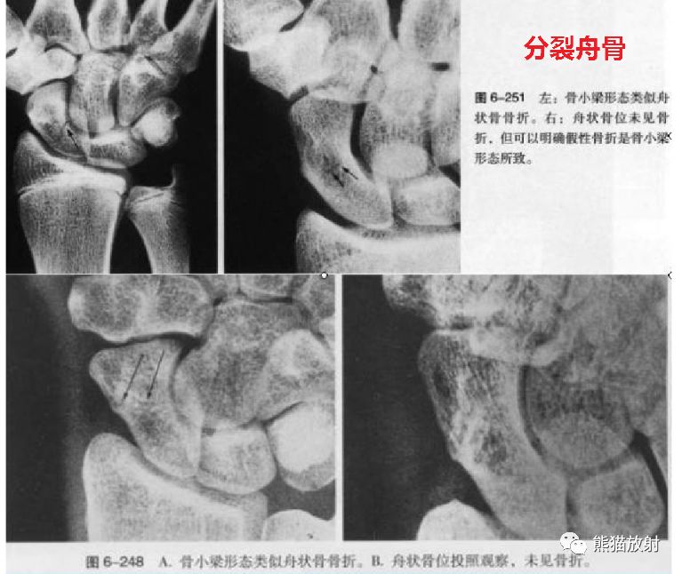 籽骨,副骨,永存骨骺,撕脱骨折?读完此文,你就懂了!