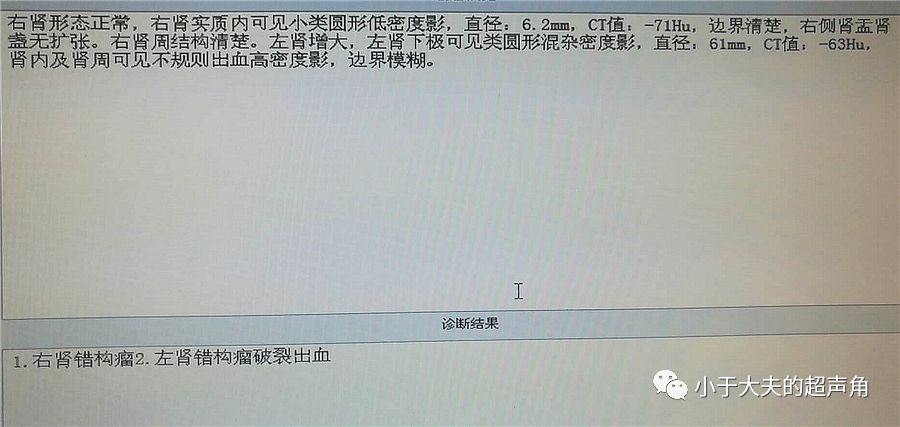 图9-10:ct显示左肾下极异常密度影(箭头所示),ct支持错构瘤破裂出血的