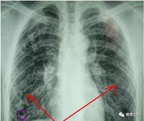 扩张,增粗的支气管 就像一条铁轨一样 在x线胸片上,可以看到 " 轨道