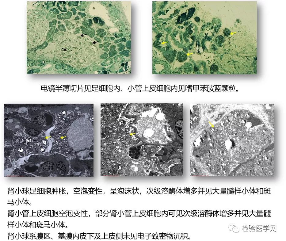 荧光显微镜,电镜三大病理诊断平台的精准检测,并接受了专业肾脏病理医