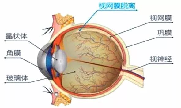 视网膜脱离:四类人要警惕