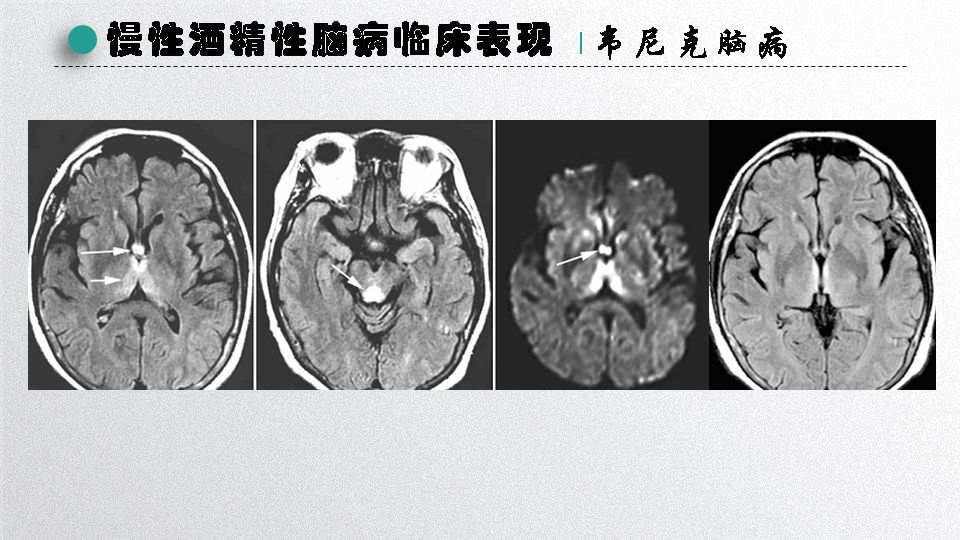 全科业务学习-王淑一-慢性酒精中毒性脑病的诊治