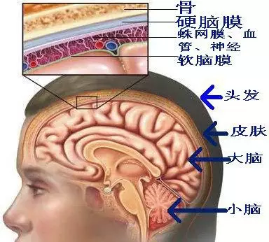 脑膜瘤主要长在蛛网膜上(第二层脑膜).