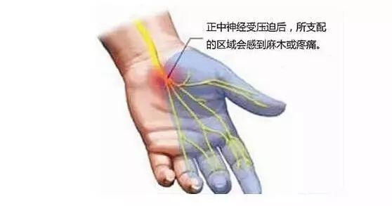 科技 正文  "鼠标手",也叫腕管综合征,是临床最常见的正中神经损伤.