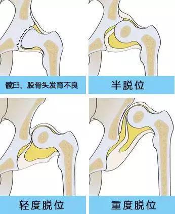 宝宝臀纹腿纹不对称?当心髋关节发育不良!得手术!