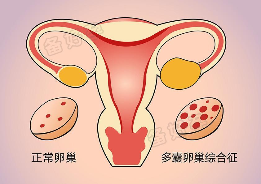 多囊想好孕,排卵期这些事情要注意