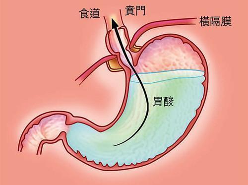 3,烧心,反酸