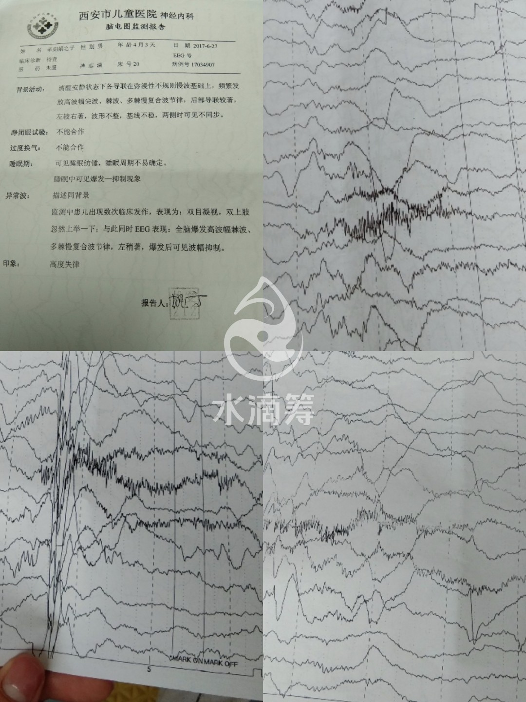 我跟老婆都不放心,带他到医院检查,被确诊为婴儿痉挛症,听到这个结果