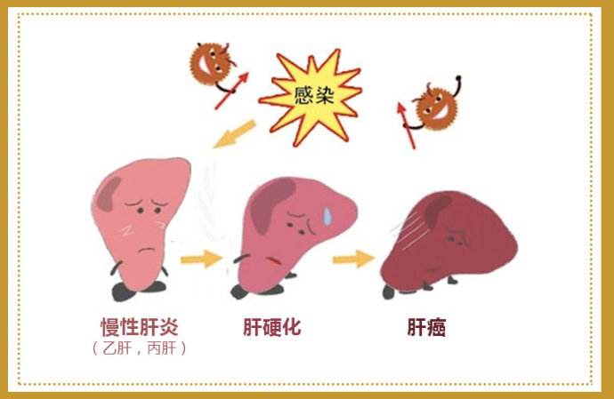 而丙肝患者距离肝癌短则5年,长则10年!丙肝离肝癌有多远?