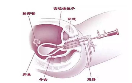 女性妇产科宫肌瘤临床表现及诊断了解.