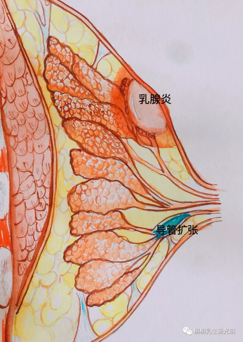 乳腺导管扩张: 又叫粉刺样乳腺炎,有的是因为乳头内陷,藏污纳垢引起