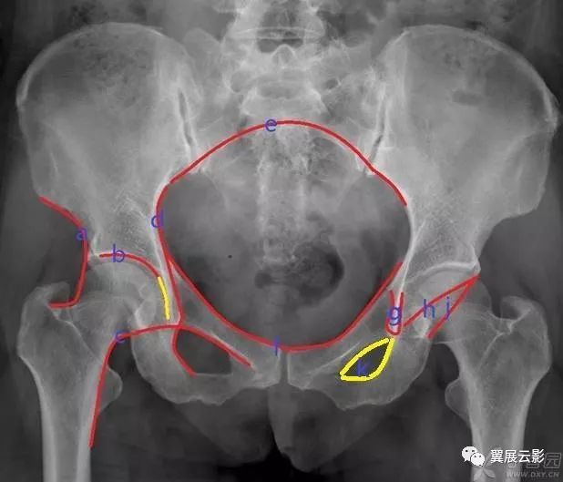 【收藏】骨盆和髋关节的x线评估及测量大全