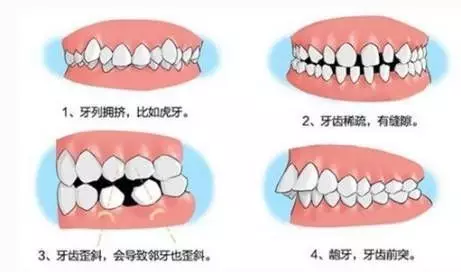 刚矫正由于牙齿受力,而出现了不适的症状,比如酸胀疼痛,咬合无力,有些